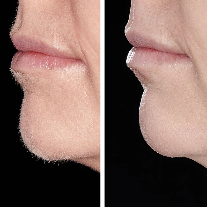Chin area dermaplaning
