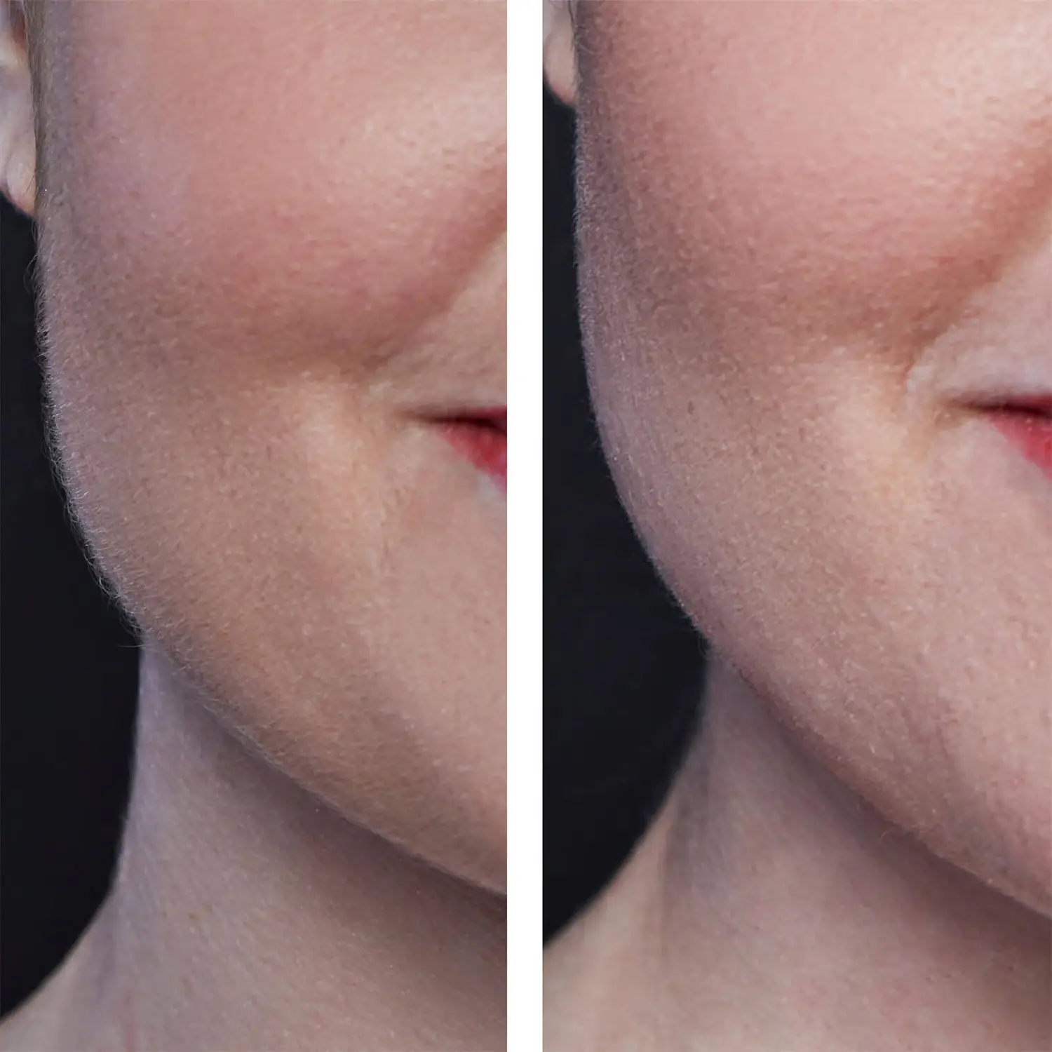 Dermaplaning result