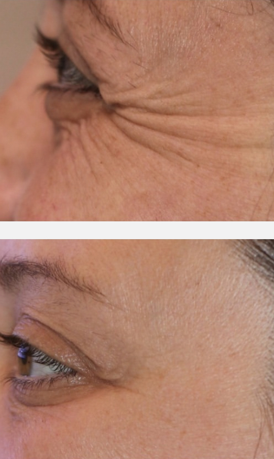 Botox treatment