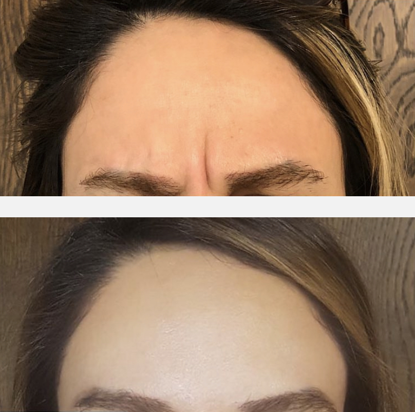 Botox results