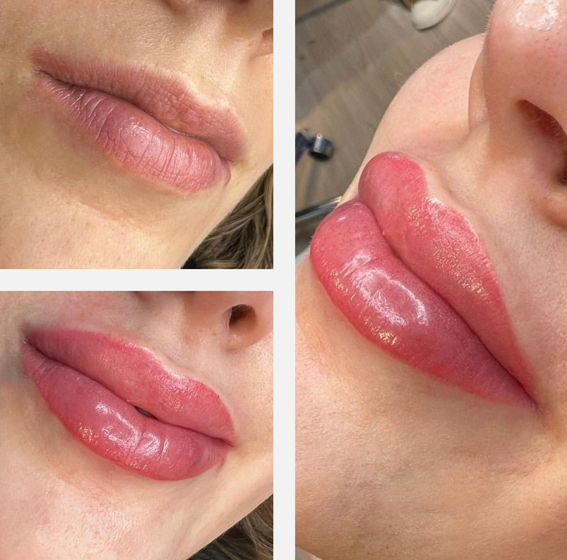 Lipblush procedure